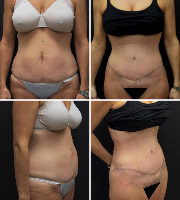 A Body Lift Can Remove Sagging Skin From Extreme Weight Loss