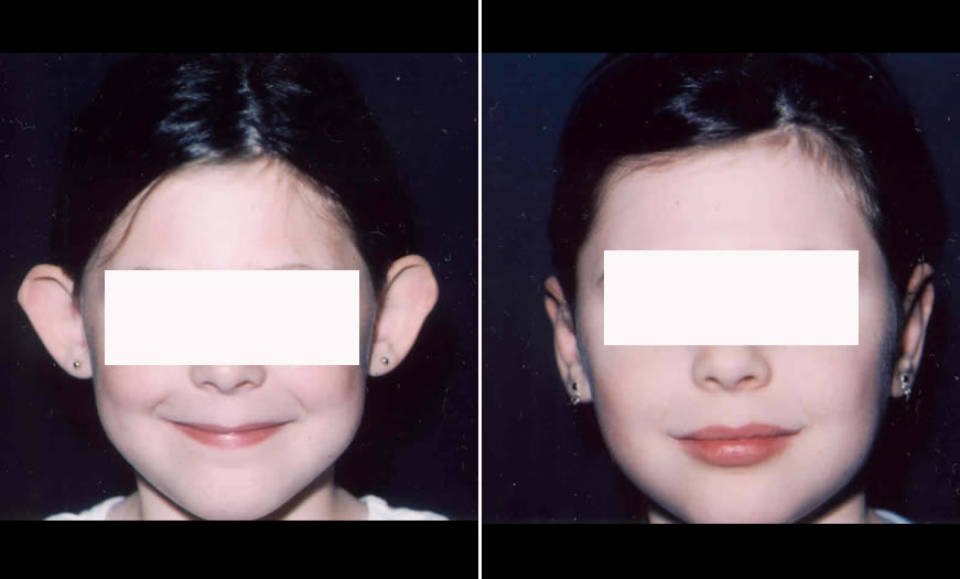 Before & After Otoplasty Front View
