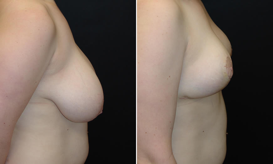 Before & After Breast Reduction Side Right