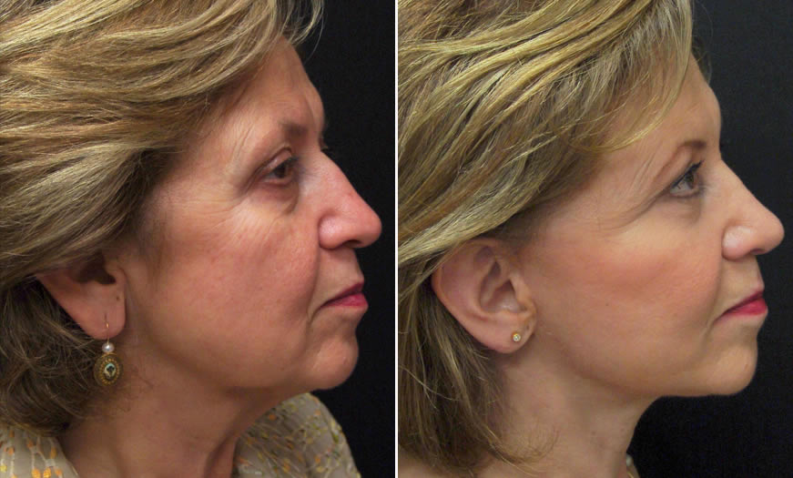 Before & After Combination Procedures Side Right View