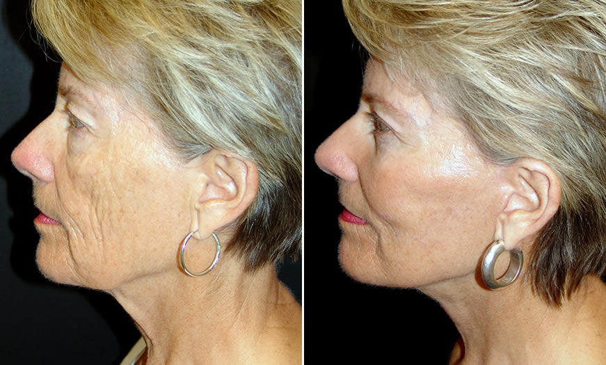 Before & After Face & Neck Lift Side Left View