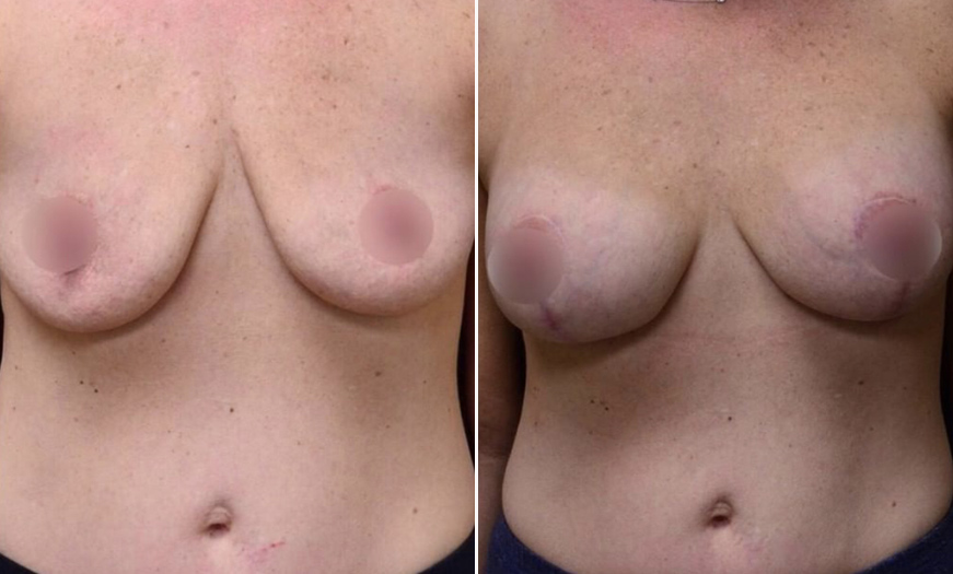 New Jersey Breast Reduction Before And After