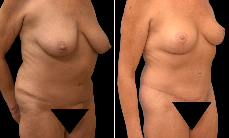 Breast Reduction Results NJ