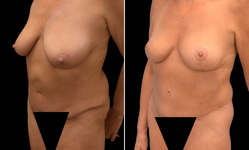 Breast Reduction Results New Jersey