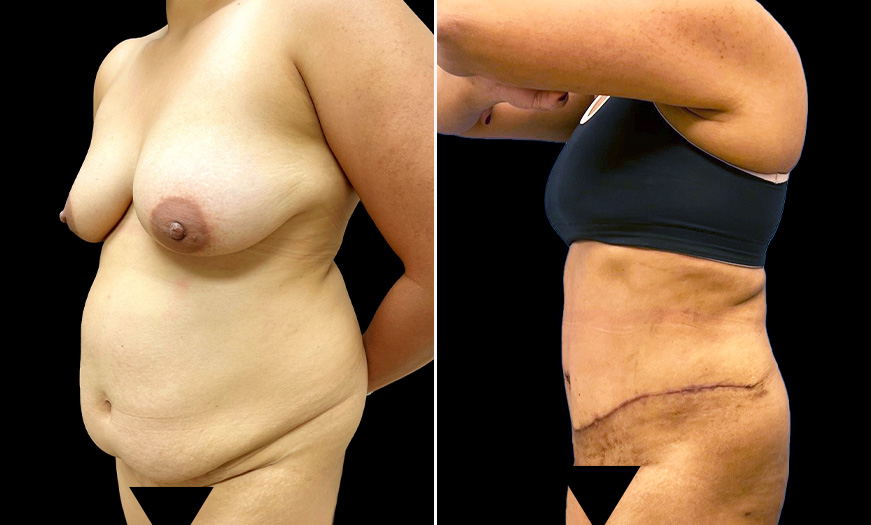 Tummy Tuck Before & After Gallery 4