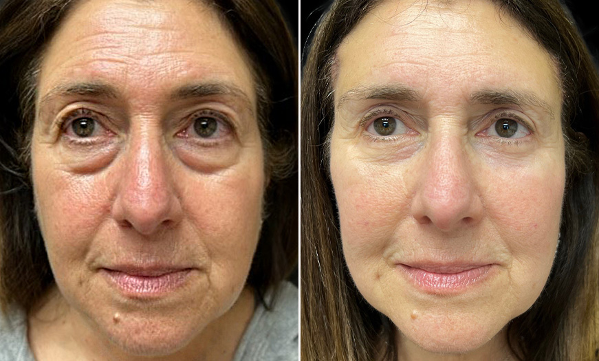 Results Of Bilateral Upper & Lower Blepharoplasty