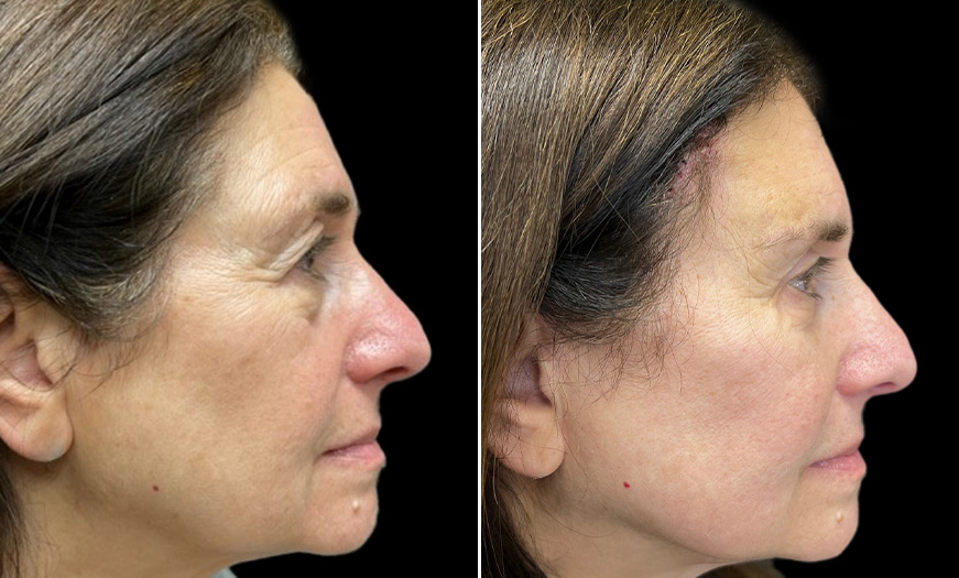 Results Of Bilateral Upper & Lower Blepharoplasty Right Side View