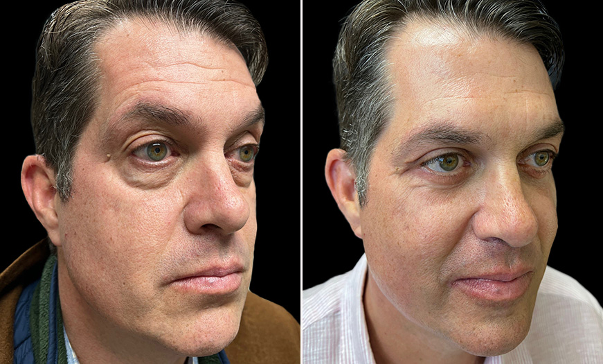 Bilateral Blepharoplasty Results NJ ¾ Right View