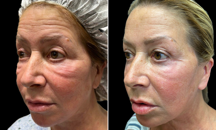 Bilateral Short Blepharoplasty Results ¾ Left View