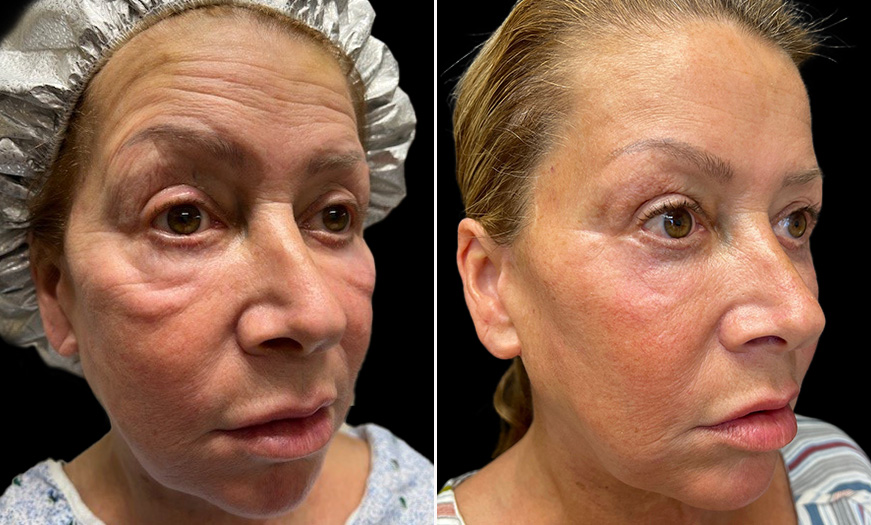 Bilateral Short Blepharoplasty Results ¾ Right View