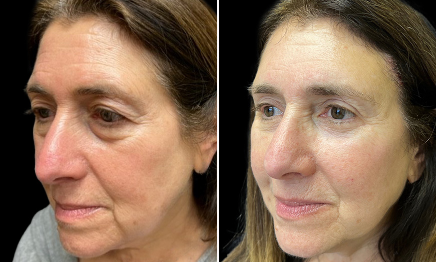 Results Of Bilateral Upper & Lower Blepharoplasty ¾ Left View