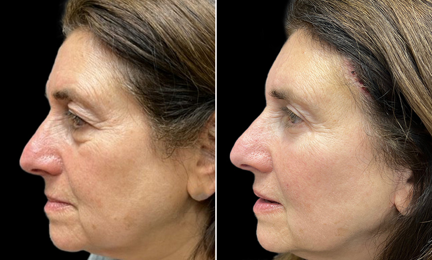 Results Of Bilateral Upper & Lower Blepharoplasty Left Side View