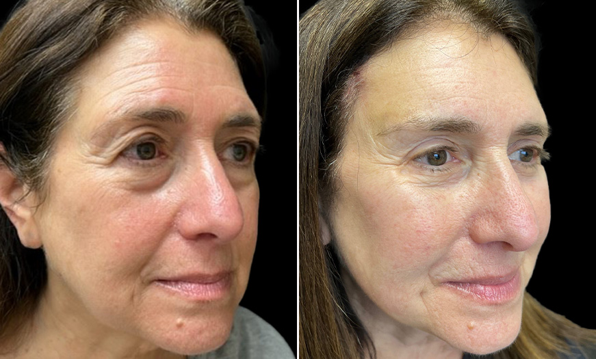 Results Of Bilateral Upper & Lower Blepharoplasty ¾ Right