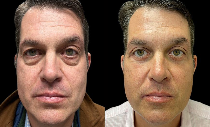 Bilateral Blepharoplasty Results NJ