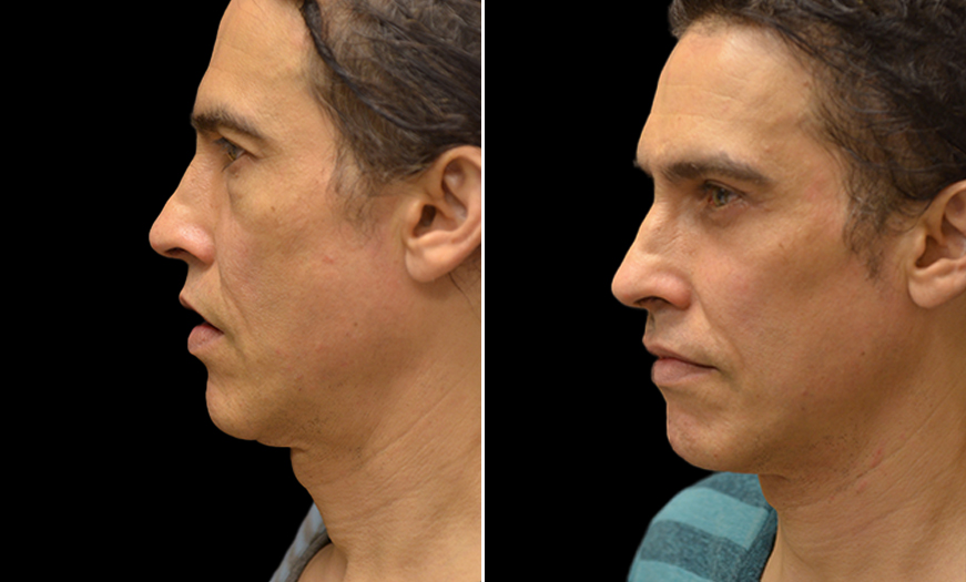 Before & After Canthopexy Surgery Left Side View