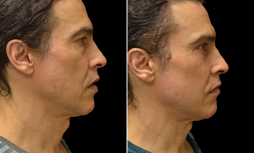 Before & After Canthopexy Surgery Right Side View