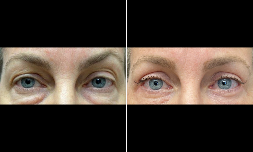 Upper & Lower Eyelid Surgery Results NJ