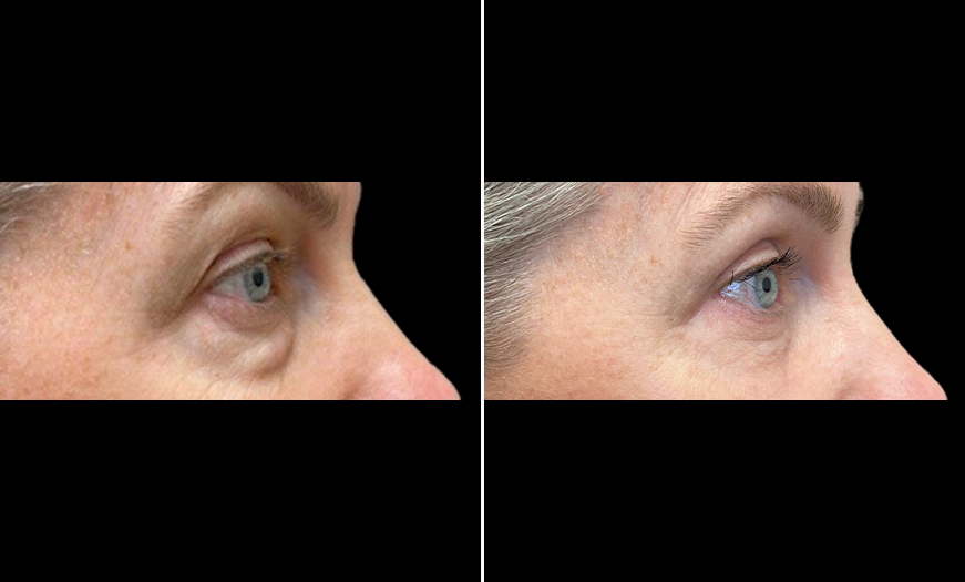 Right Side View Upper & Lower Eyelid Surgery Results