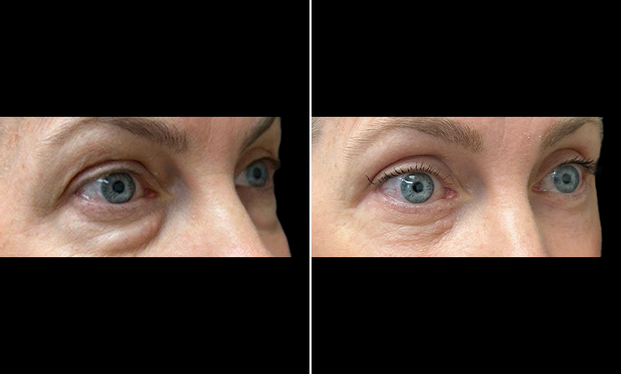 ¾ Right View Upper & Lower Eyelid Surgery Results