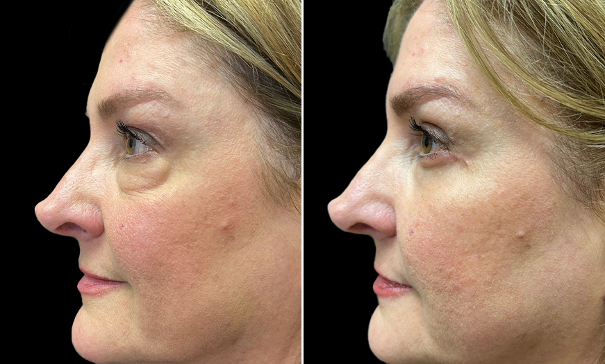 Left Side View Upper And Lower Eyelid Surgery Results