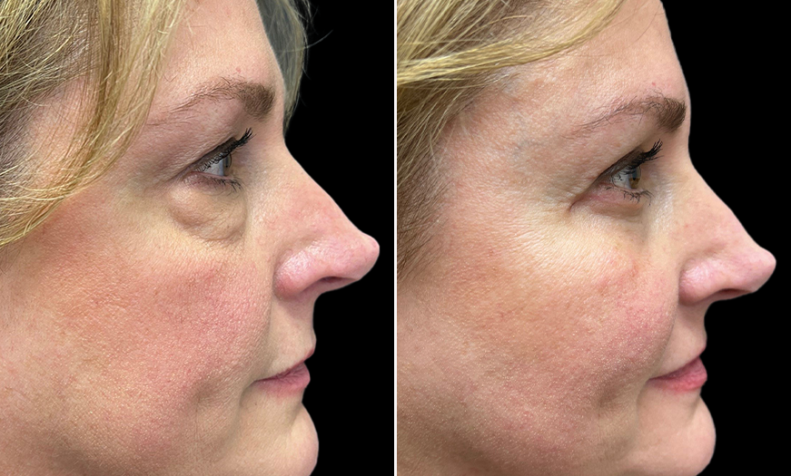 Right Side View Upper And Lower Eyelid Surgery Results