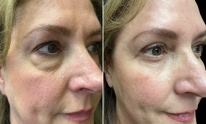 ¾ Right View Upper And Lower Eyelid Surgery Results