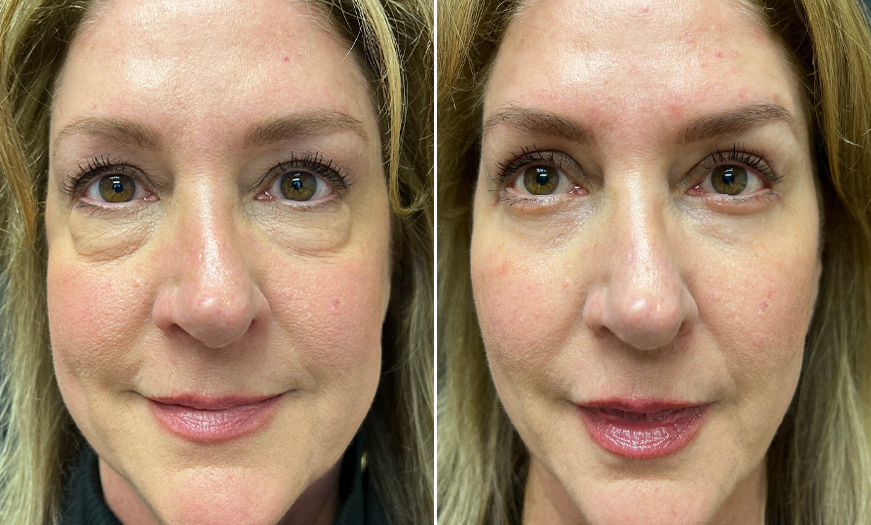 Upper And Lower Eyelid Surgery Results NJ
