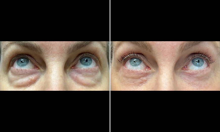 Results Of Upper & Lower Eyelid Surgery NJ