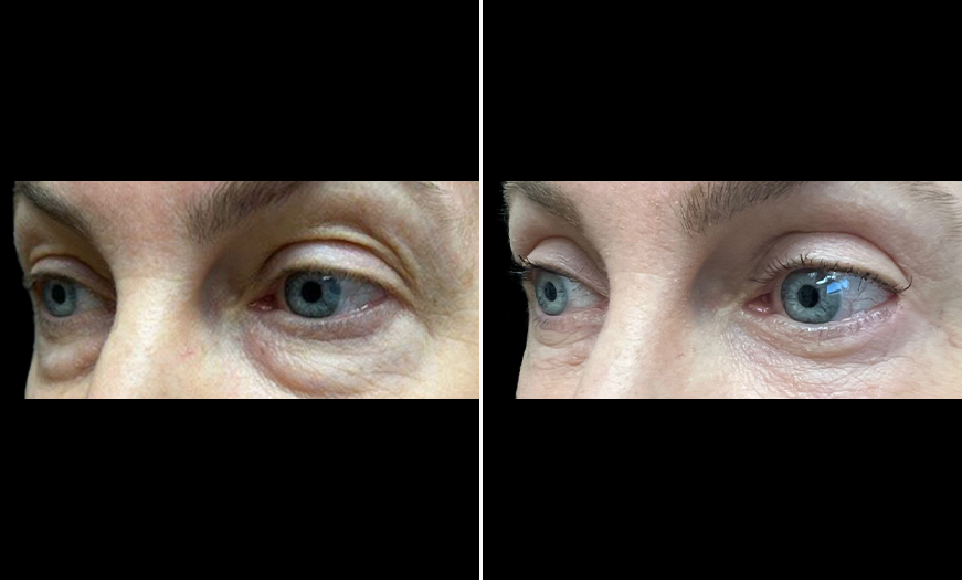 ¾ Left View Upper & Lower Eyelid Surgery Results