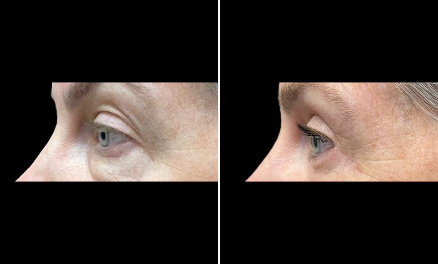 Left Side View Upper & Lower Eyelid Surgery Results