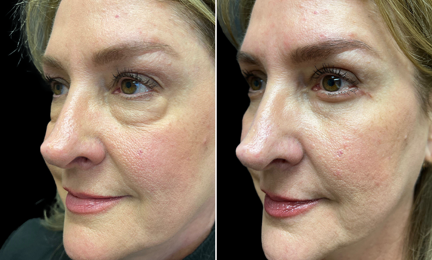 ¾ Left View Upper And Lower Eyelid Surgery Results