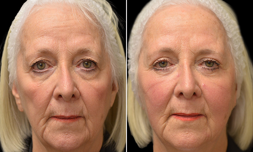 Canthoplasty & Canthopexy Surgery Results