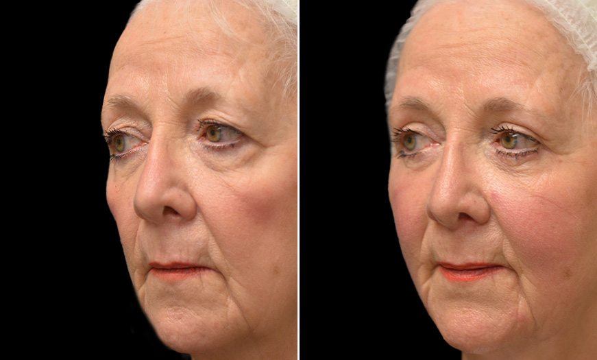 Canthoplasty & Canthopexy Surgery Results ¾ Left View