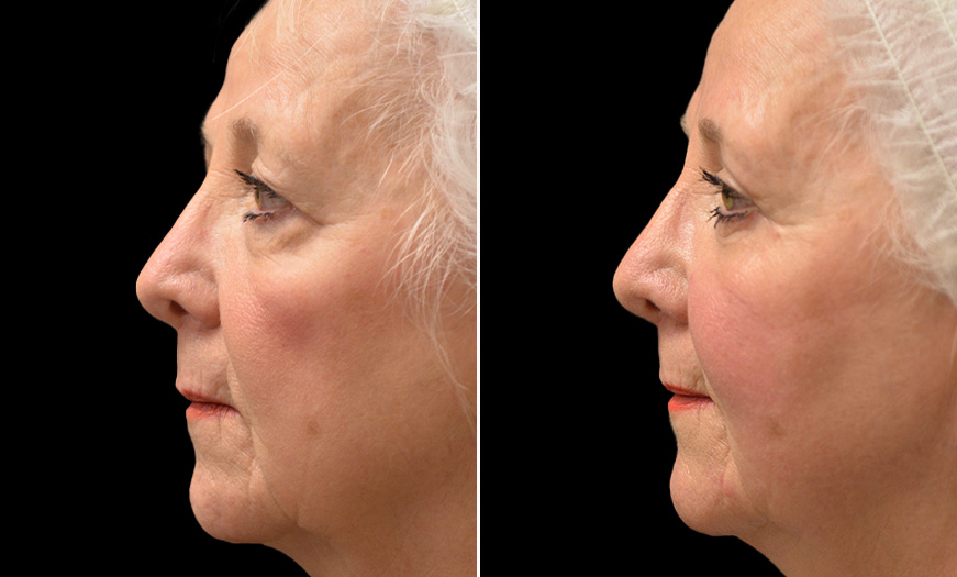 Canthoplasty & Canthopexy Surgery Results Left View