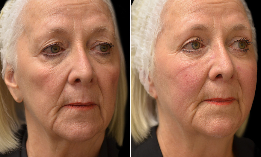 Canthoplasty & Canthopexy Surgery Results ¾ Right View