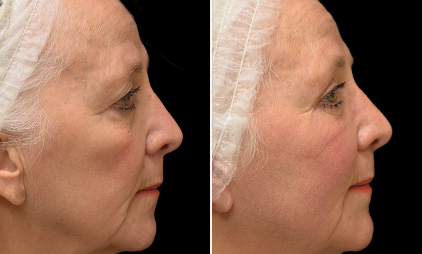 Canthoplasty & Canthopexy Surgery Results Right View