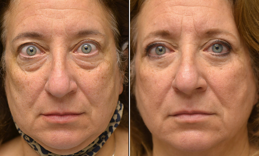 New Jersey Canthoplasty And Canthopexy Results