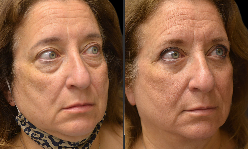 New Jersey Canthoplasty And Canthopexy Result ¾ Right View