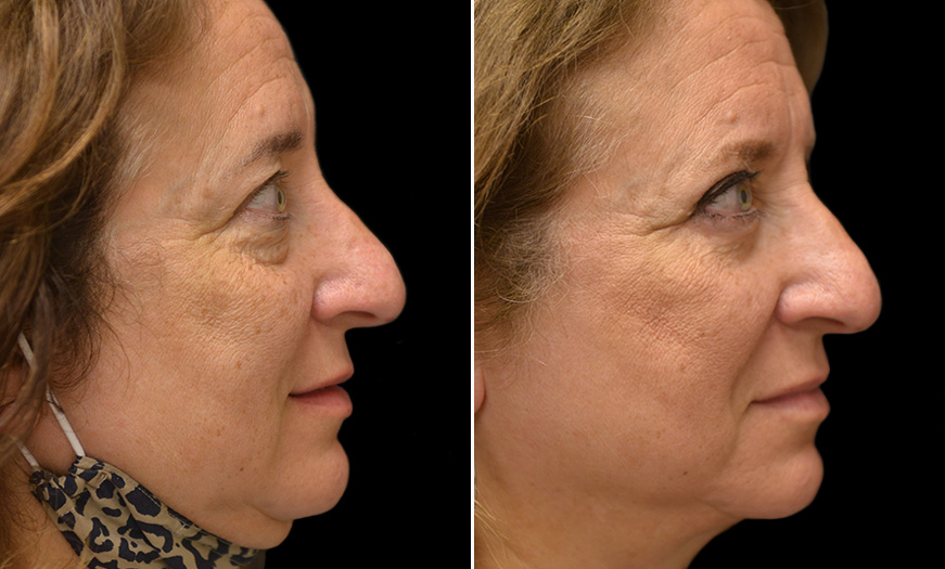 New Jersey Canthoplasty And Canthopexy Result Right View