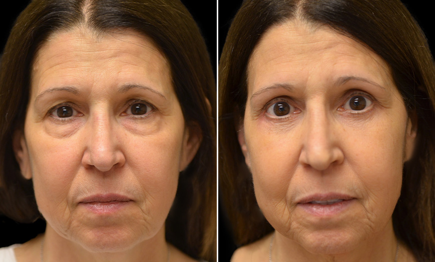 NJ Canthoplasty And Canthopexy Results