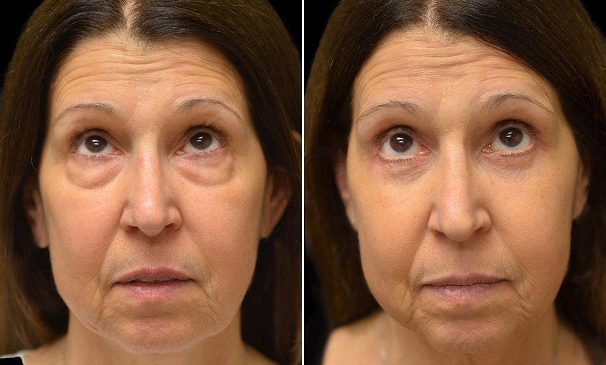 NJ Canthoplasty And Canthopexy Results Front View