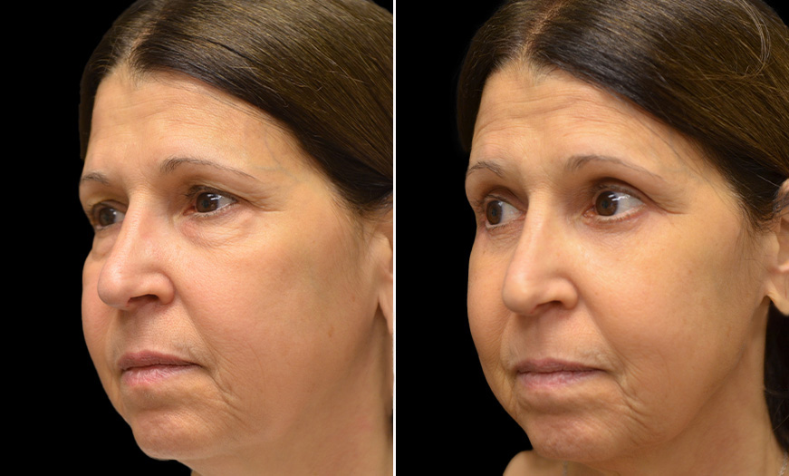 NJ Canthoplasty And Canthopexy Results ¾ Left View