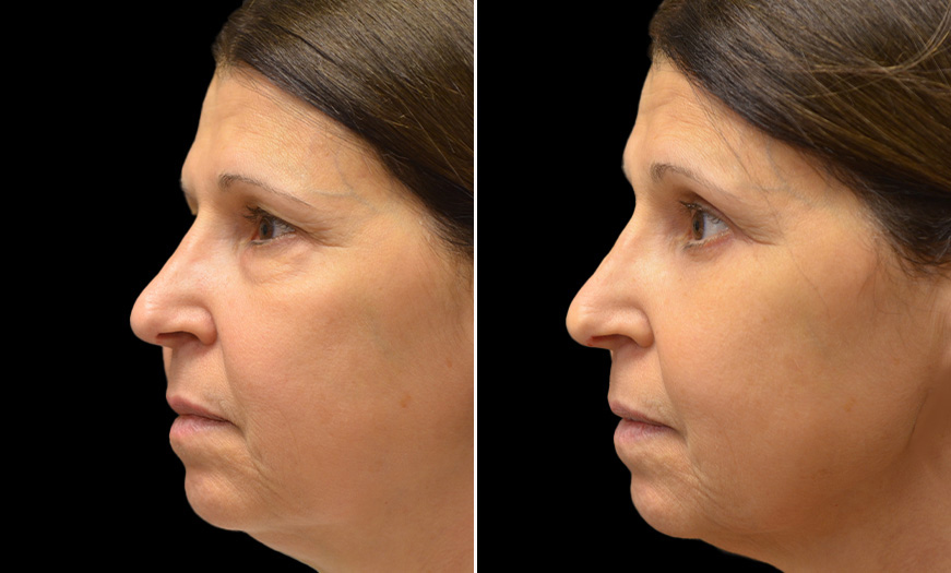 NJ Canthoplasty And Canthopexy Results Left View