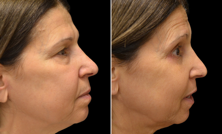 NJ Canthoplasty And Canthopexy Results Right View