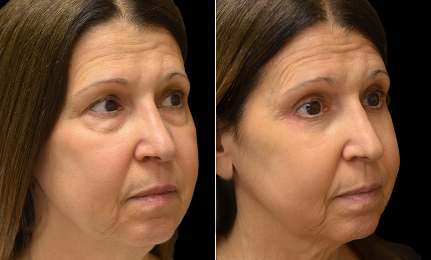 NJ Canthoplasty And Canthopexy Results ¾ Right View 