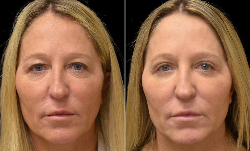 Results Of Canthoplasty & Canthopexy In NJ