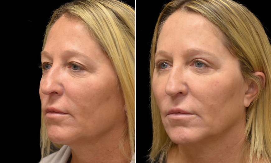 Results Of Canthoplasty & Canthopexy In NJ ¾ Left View