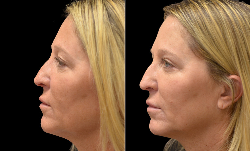 Results Of Canthoplasty & Canthopexy In NJ Left View