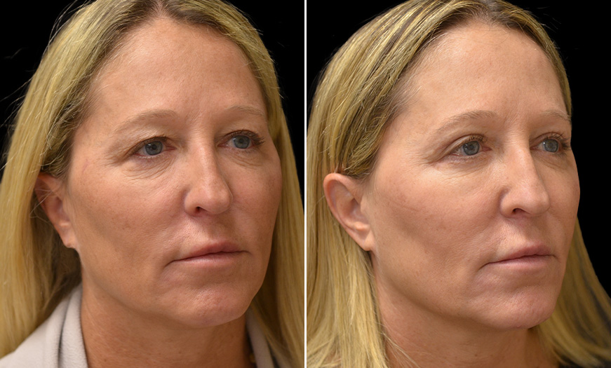 Results Of Canthoplasty & Canthopexy In NJ ¾ Right View