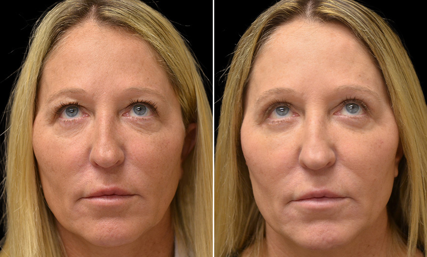 Results Of Canthoplasty & Canthopexy In NJ Front View